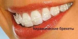 Керамические брекеты