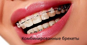 Комбинированные брекеты