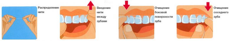 Десна кровоточат при чистке зубной нитью